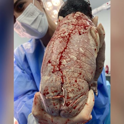 Bebê nasce com DIU preso ao corpo