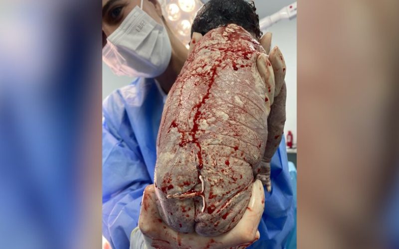 Bebê nasce com DIU preso ao corpo