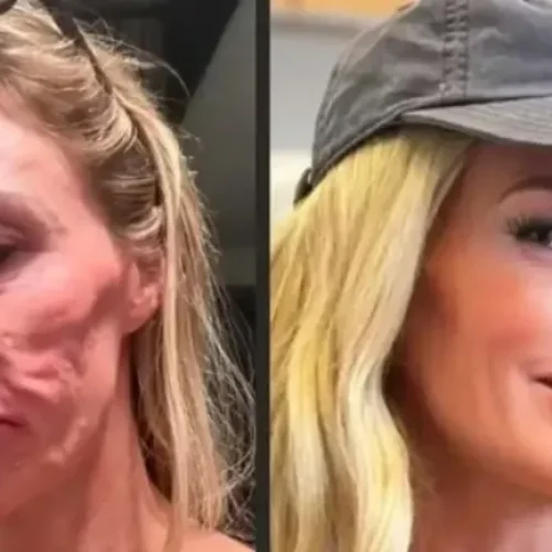 Influenciadora diz ter procurado 21 médicos após derretimento facial