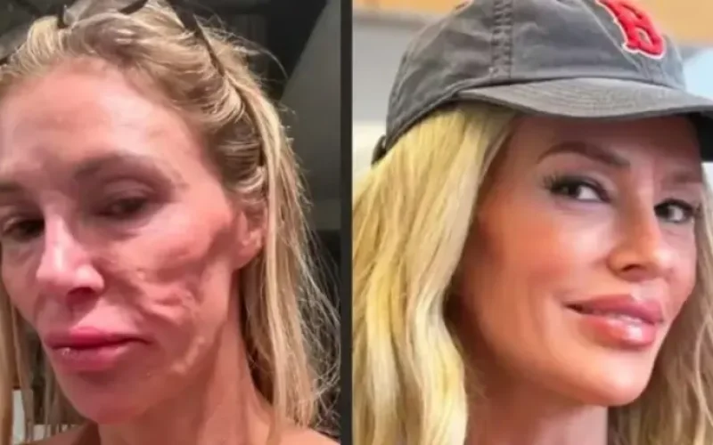 Influenciadora diz ter procurado 21 médicos após derretimento facial