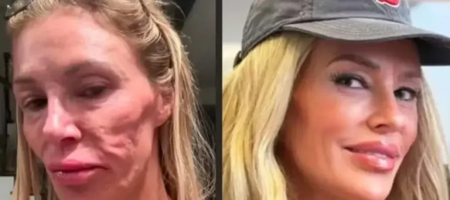 Influenciadora diz ter procurado 21 médicos após derretimento facial