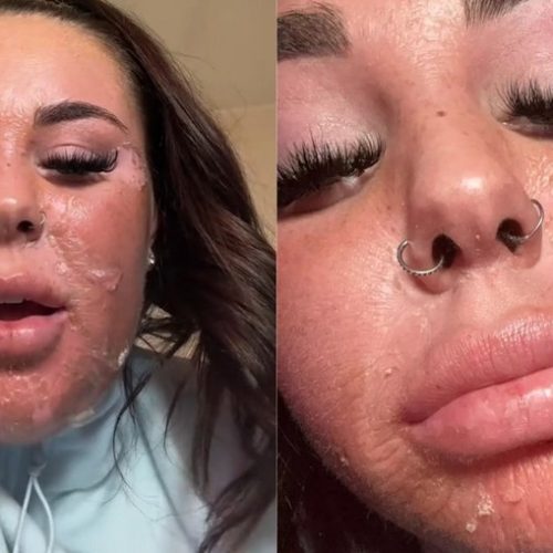 Erro: mulher é hospitalizada após bronzeamento artificial