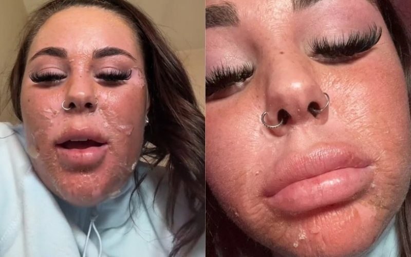 Erro: mulher é hospitalizada após bronzeamento artificial