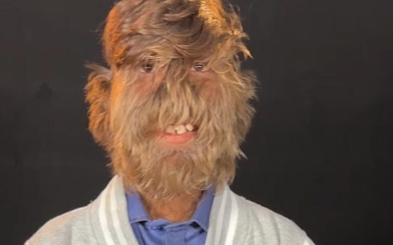 Lobisomem indiano entra no Guinness por rosto mais peludo